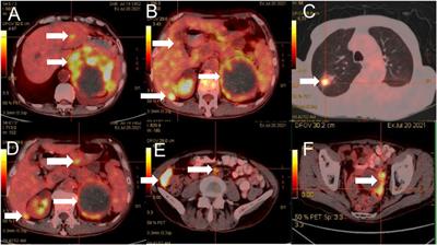 Epithelioid hemangioendothelioma of the retroperitoneal giant type treated with Toripalimab: A case report